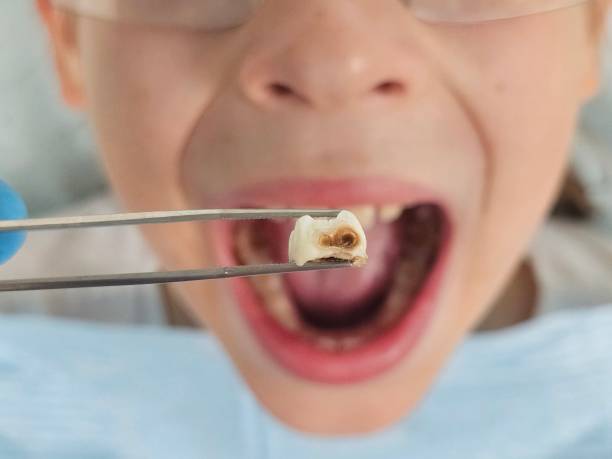 Best Emergency Broken Tooth Repair in Devens, MA